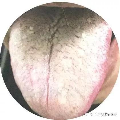 舌苔厚的明星网红,揭秘明星舌苔背后的健康密码