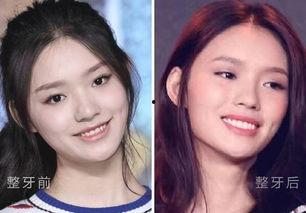明星网红做假牙视频,揭秘明星美牙秘密
